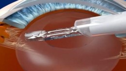 SpyGlass Pharma naar Nasdaq; Gilde Healthcare betrokken als investeerder